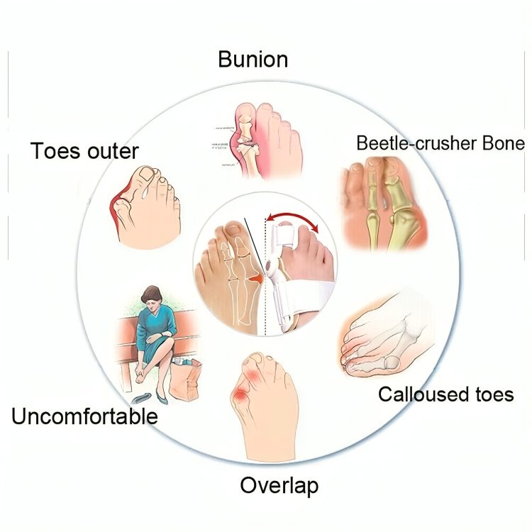 Bunion Corrector